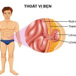 Bệnh thoát vị bẹn – nguyên nhân và cách điều trị