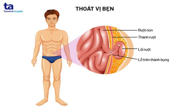 nguyên nhân gây thoát vị bẹn