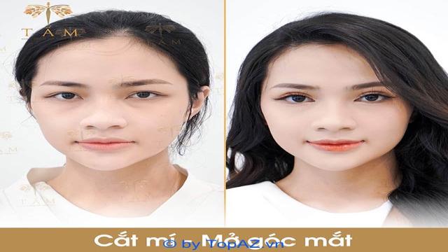 Cắt mí mở góc mắt thẩm mỹ viện tấm tại Hà Nội