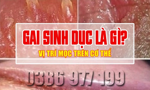 Gai sinh dục là gì, thường mọc ở đâu trên cơ thể?