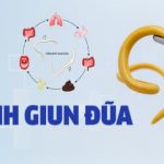 Bệnh giun đũa: Nguyên nhân, triệu chứng, chẩn đoán, phòng ngừa