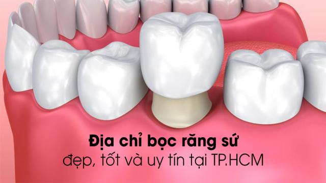 Địa chỉ bọc răng sứ tốt và uy tín tại TP.HCM