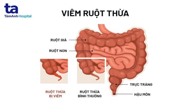 vị trí đau ruột thừa