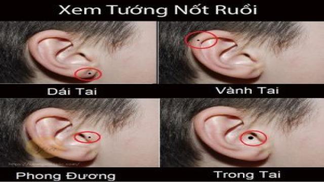 Nữ giới có nốt ruồi ở cuống tai thường sức khỏe yếu