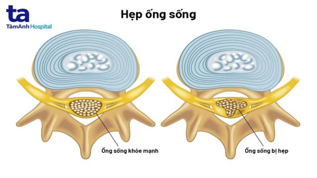 căn bệnh hẹp ống sống