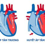 Huyết áp tâm thu là gì? Biểu hiện và cách phòng tránh